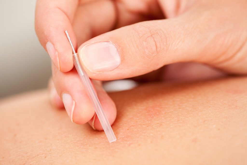 Dry needling dry creek physical therapy