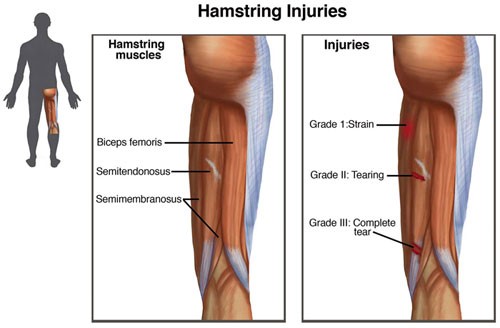 Hamstring Injury